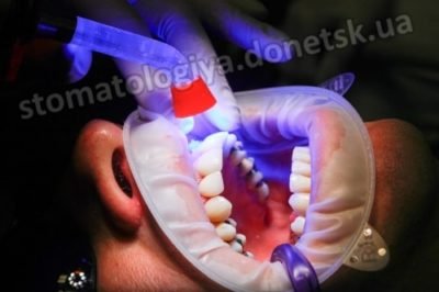 художественная реставрация зубов Донецк