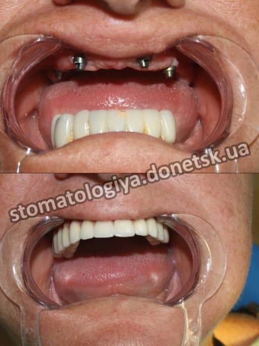 имплантация зубов Донецк all-on-4