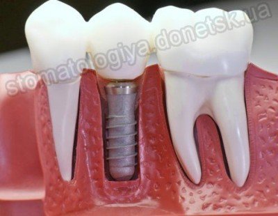 имплантация зубов донецк