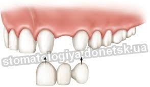 протезирование зубов донецк мост