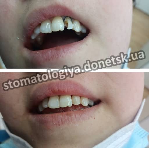 стоматология в Донецке поставить пломбу цена