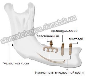 внутрикостные импланты зубов в донецке